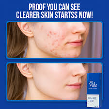Wiki Special Serum for Anti-Acne